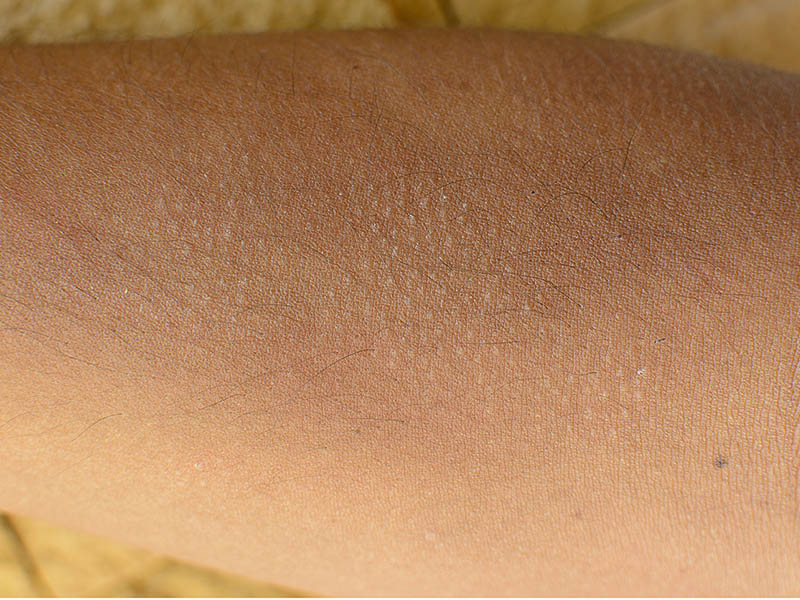 Close-up view of keratosis pilaris papules (bumps)