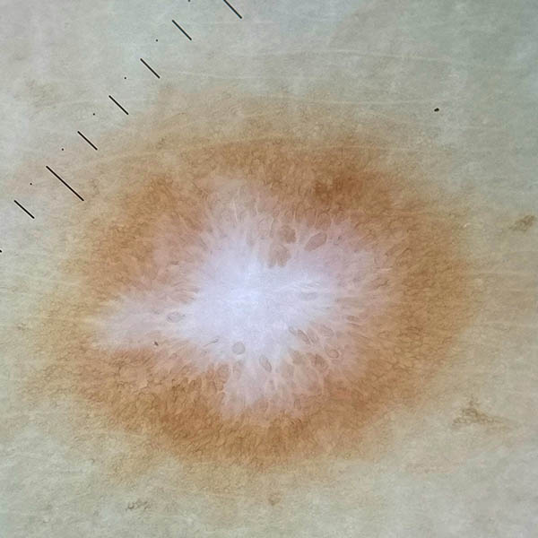 Dermoscopic view of a dermatofibroma, showing structureless pale central area surrounded by pigment network