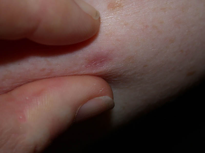 Dermatofibroma pinch sign - the skin puckers when pinched over the dermatofibroma