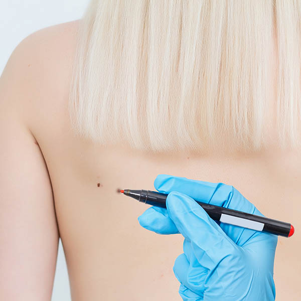 Diathermy/electrosurgery of a lesion on a woman's left shoulderblade