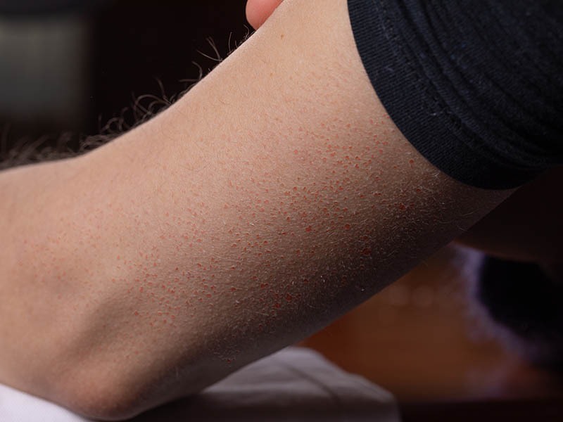 Female arm with keratosis pilaris with red papules