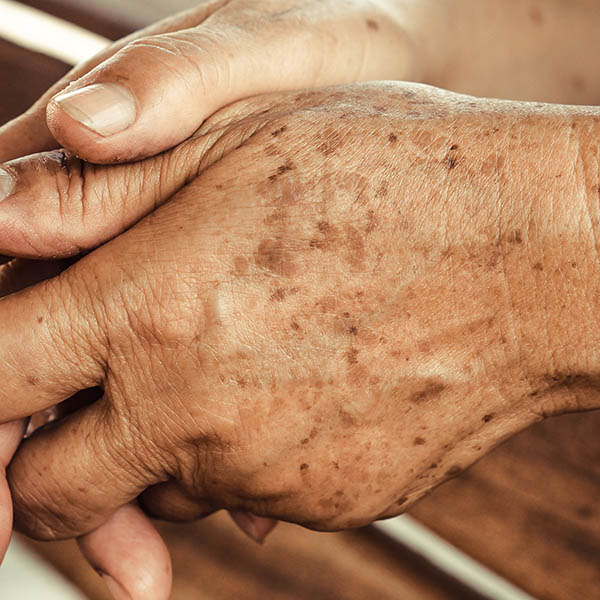 Close-up view of lentigines on the back of the hand