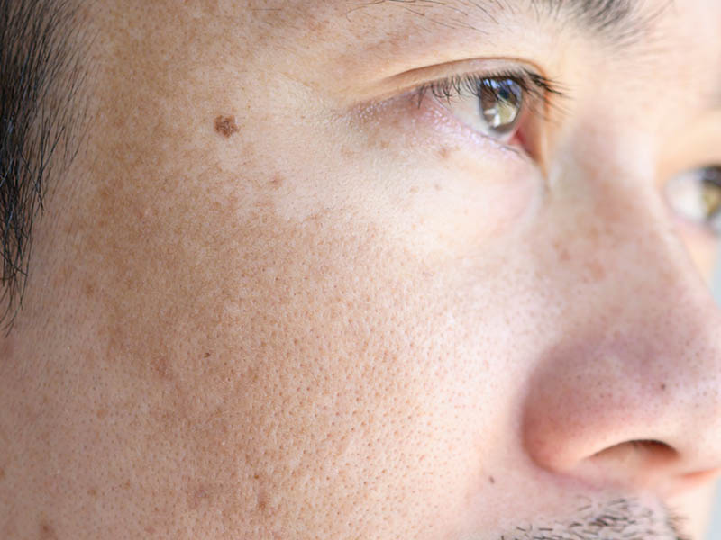 Close-up view, melasma on the cheek and temple of a young man