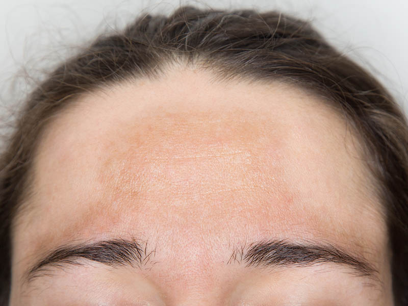 Close-up view of melasma on a young woman's forehead