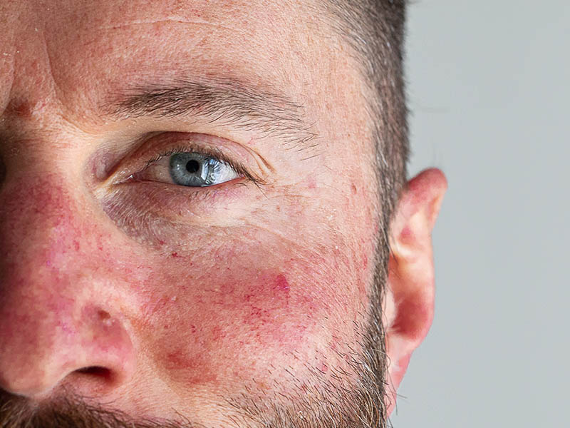 Rosacea affecting a man's cheek and nose