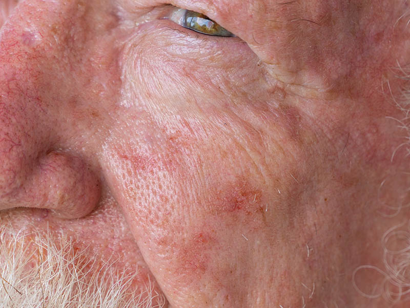 Sun damage on the cheek: wrinkles and telangiectasia (capillaries) visible on the cheek and nose