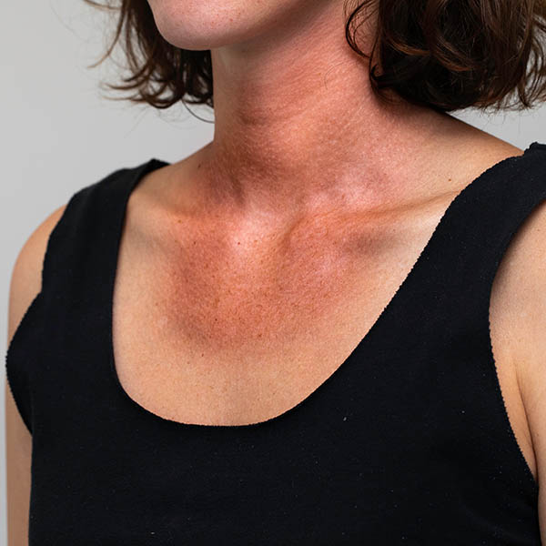 Sun damaged skin on a woman's chest