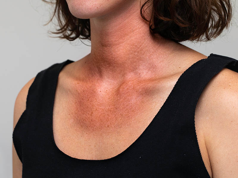 Sun damaged skin on a woman's chest