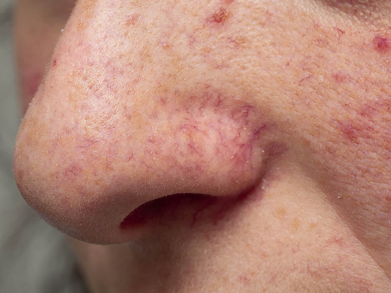 Close-up view of telangiectasia of the nose, as seen in rosacea