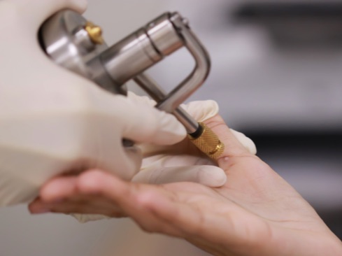 A close-up of a cryotherapy treatment