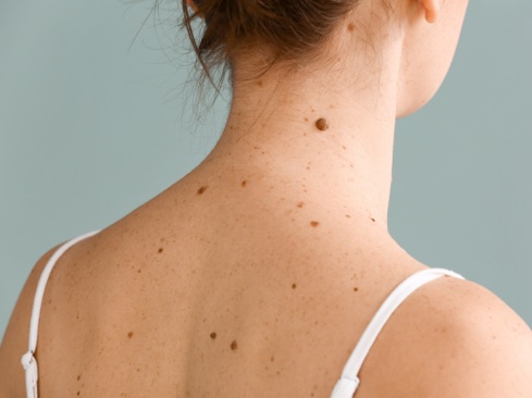 A close up of moles on back of a woman