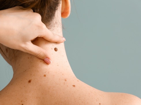 A close up of moles on back of a woman's neck