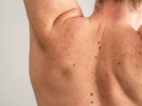 A close up of moles on back with arms raised