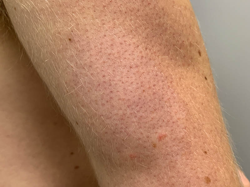 Keratosis pilaris: back view of a man's upper arm