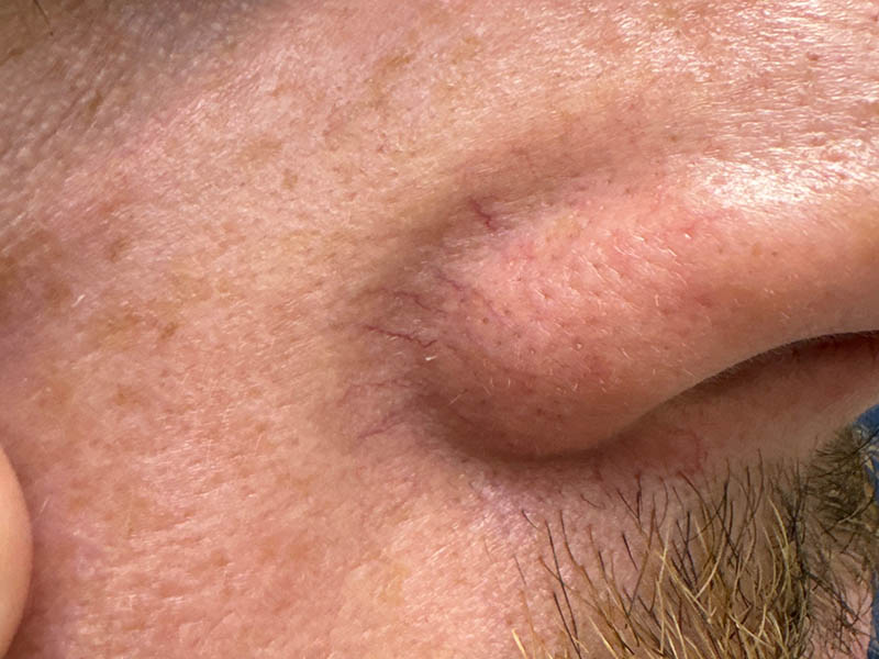 Isolated telangiectasia of the nose, as seen in sun-damaged skin.