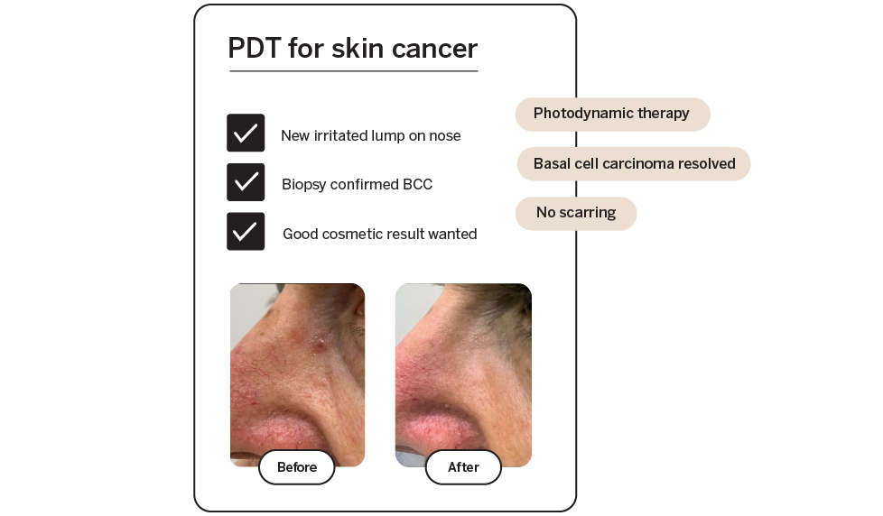 Before and after PDT for skin cancer BCC nose - call to action