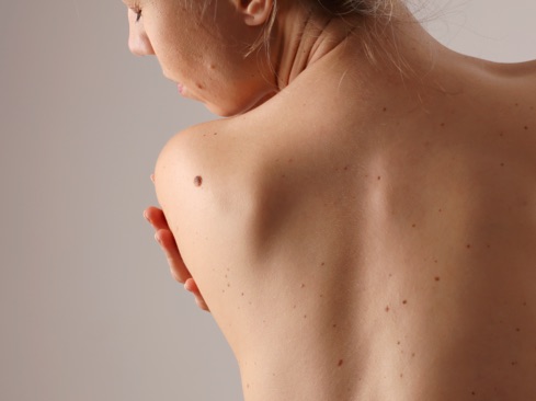 Woman showing moles on back