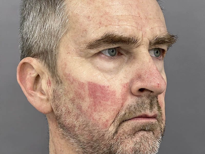 Face immediately after fractional laser treatment