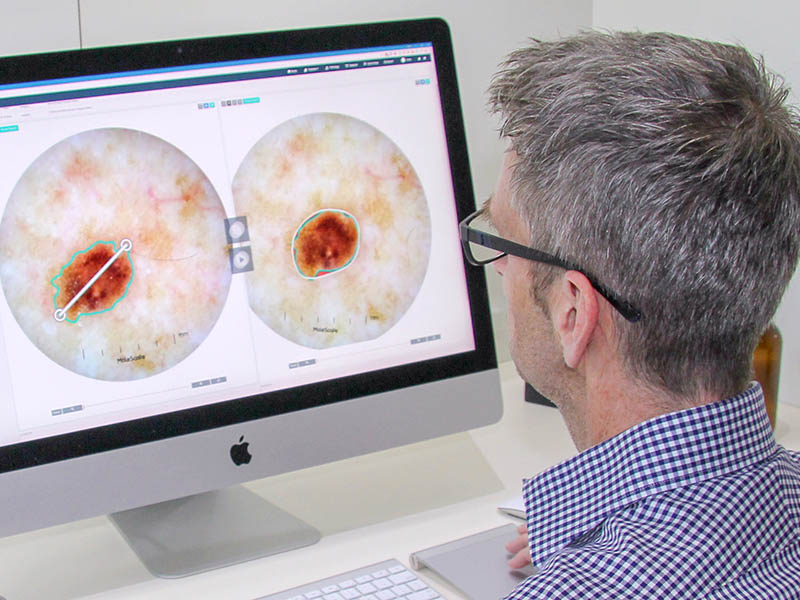 Doctor examines photos of moles on a computer, software analysis of photos