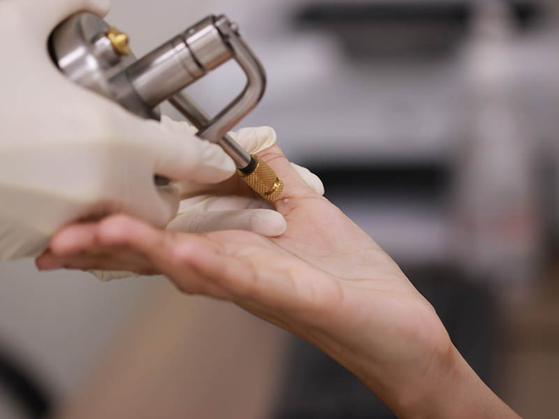 Cryotherapy spray treating lesion on a woman's hand