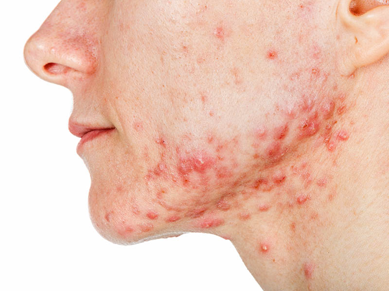 Cystic acne affecting the jawline