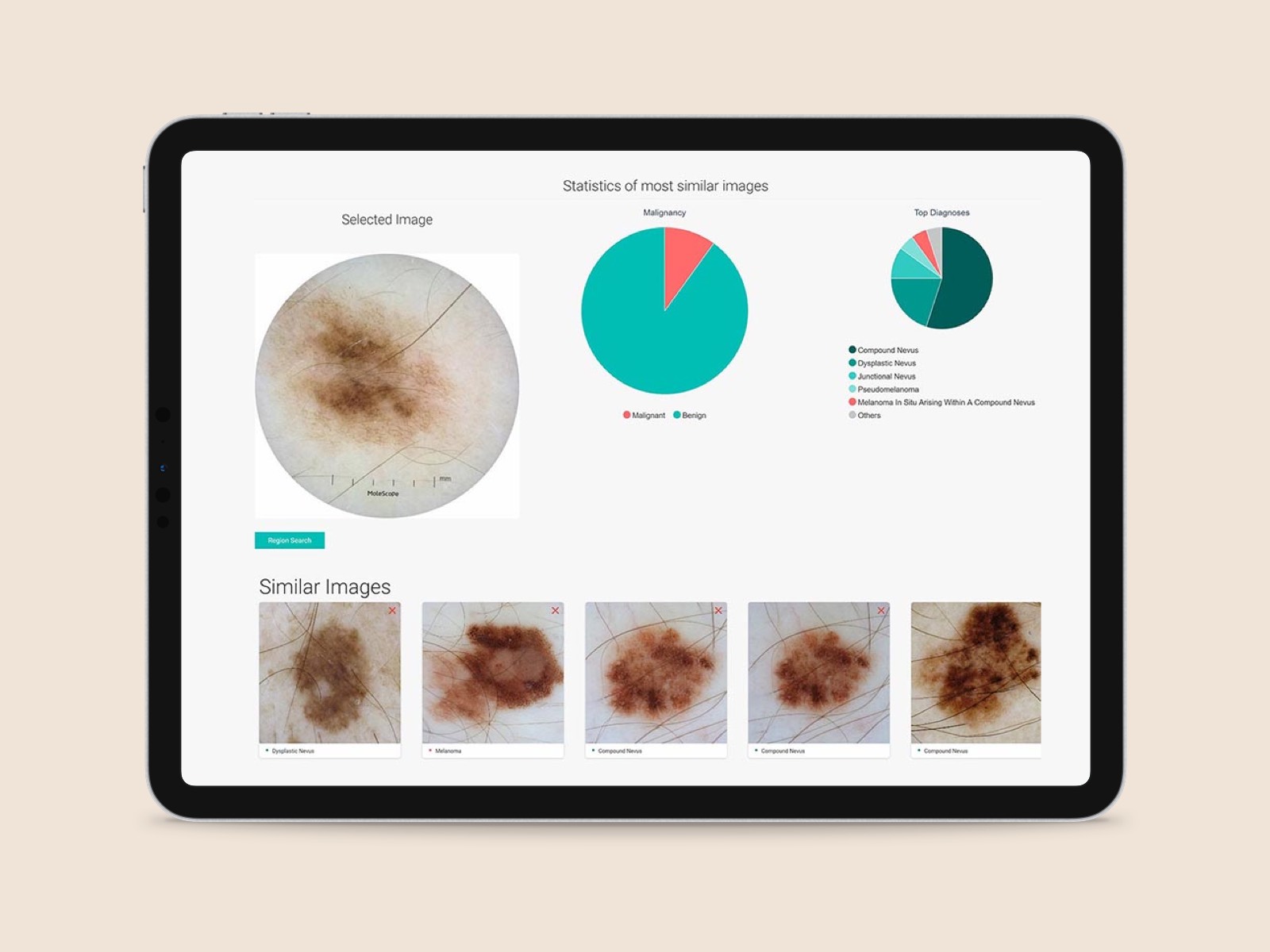 Screenshot of DermEngine Visual Search displaying patient's lesion and other comparable lesions. Potential diagnoses and probability of malignancy are displayed in charts.