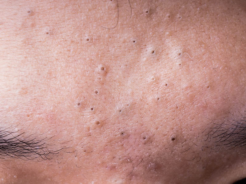 Acne of the forehead, showing open comedones, also known as blackheads