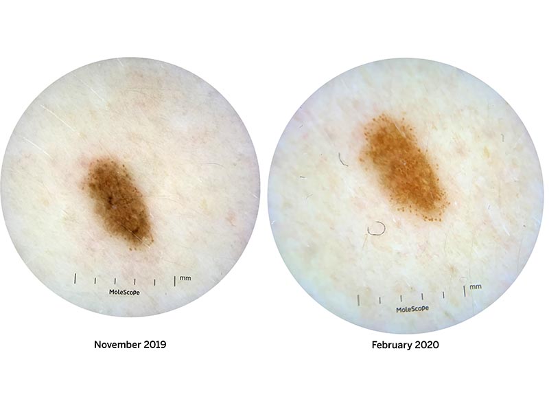 Growing melanoma, serial dermoscopic photography