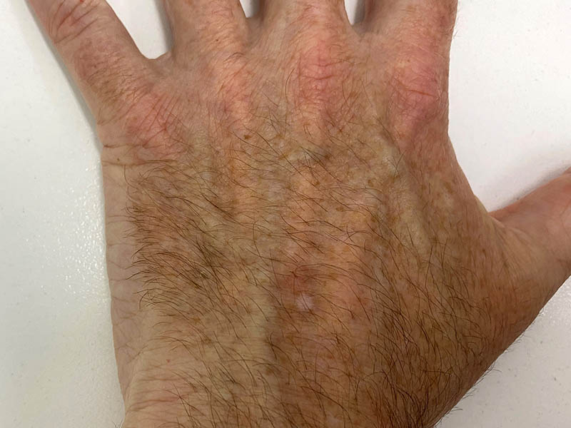 Hypopigmentation (pale skin) following cryotherapy to the back of the hand