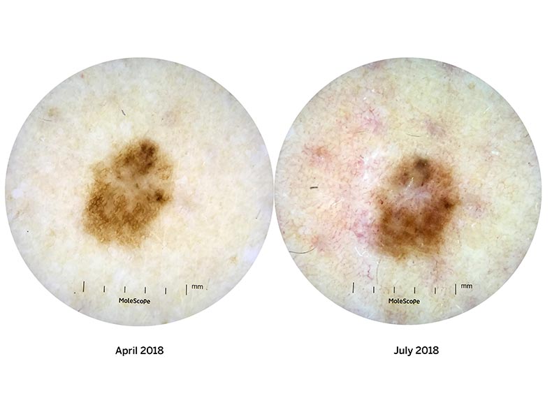 Serial dermoscopic photography of a melanoma. Photos taken 3 months apart.