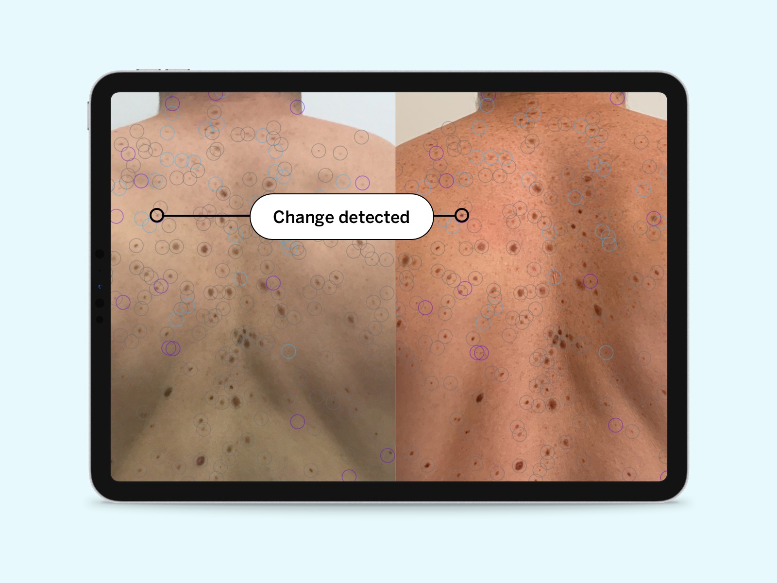 DermEngine mole mapping software compares photographs of a human back taken at different times and identifies which moles have changed.