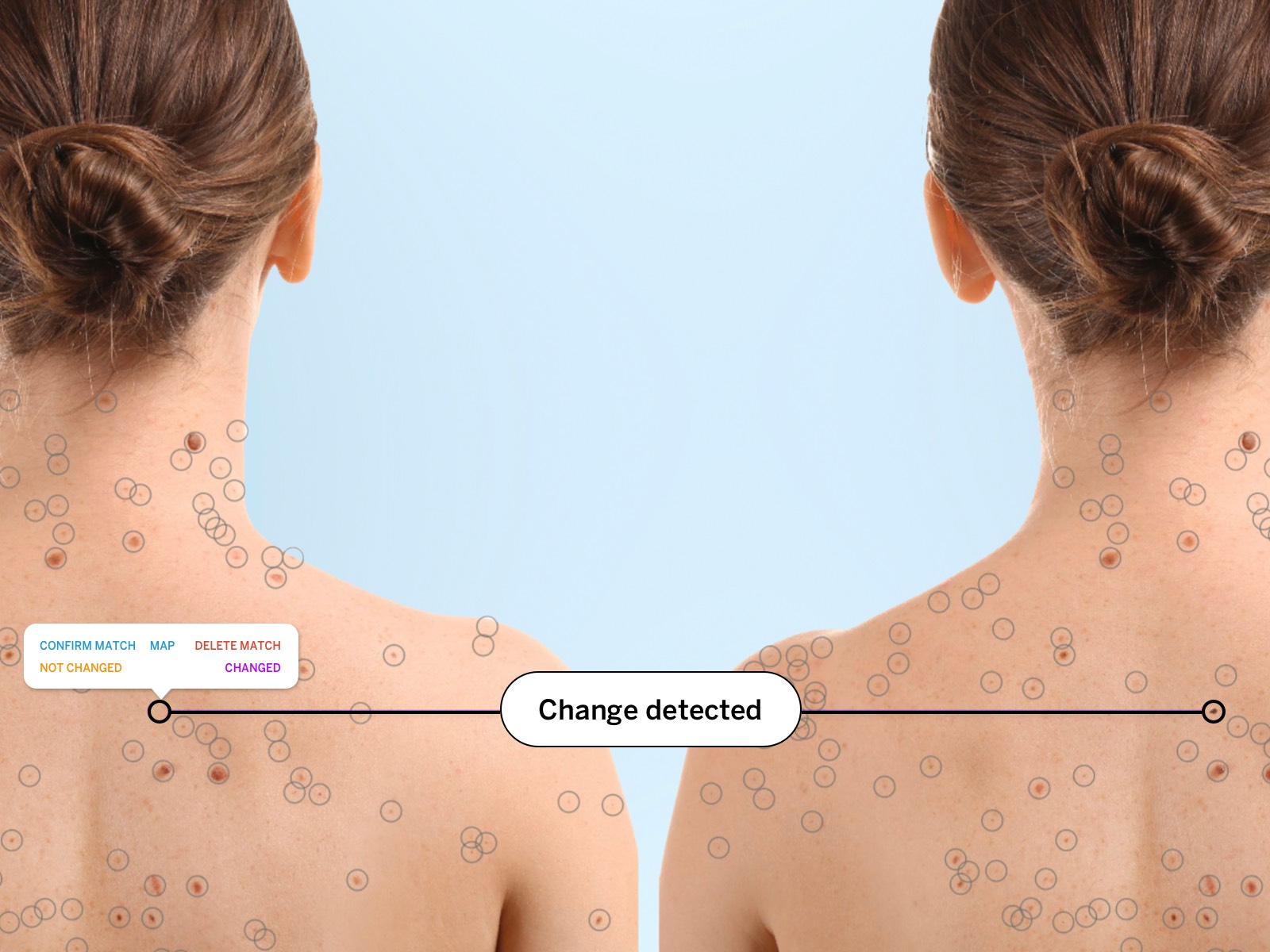 Mole mapping photos of a woman's back. Individual moles are detected and one is highlighted as changed