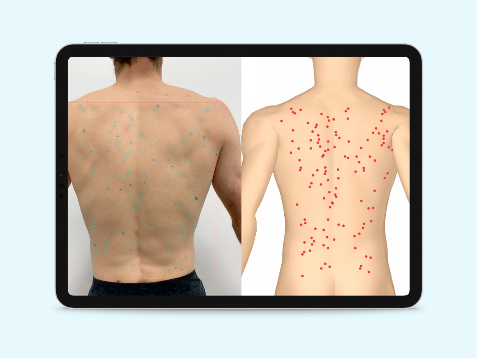 Moles from photograph of human back are mapped onto a computer simulation with DermEngine software.