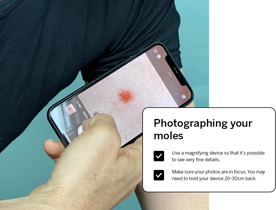 Photographing your moles - dot points