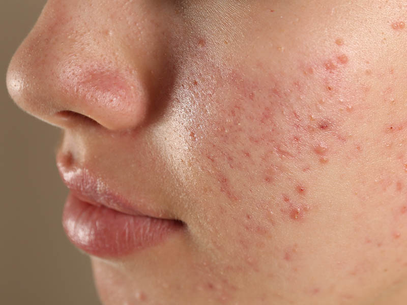 Young woman with acne pustules, papules and inflammation