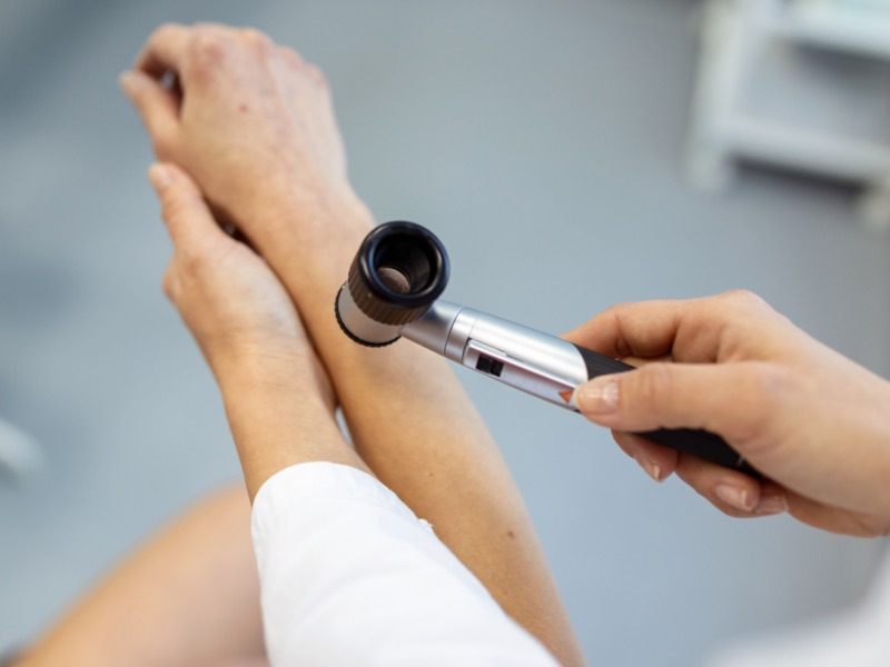 Where to get moles checked: Finding a clinic to perform a mole check