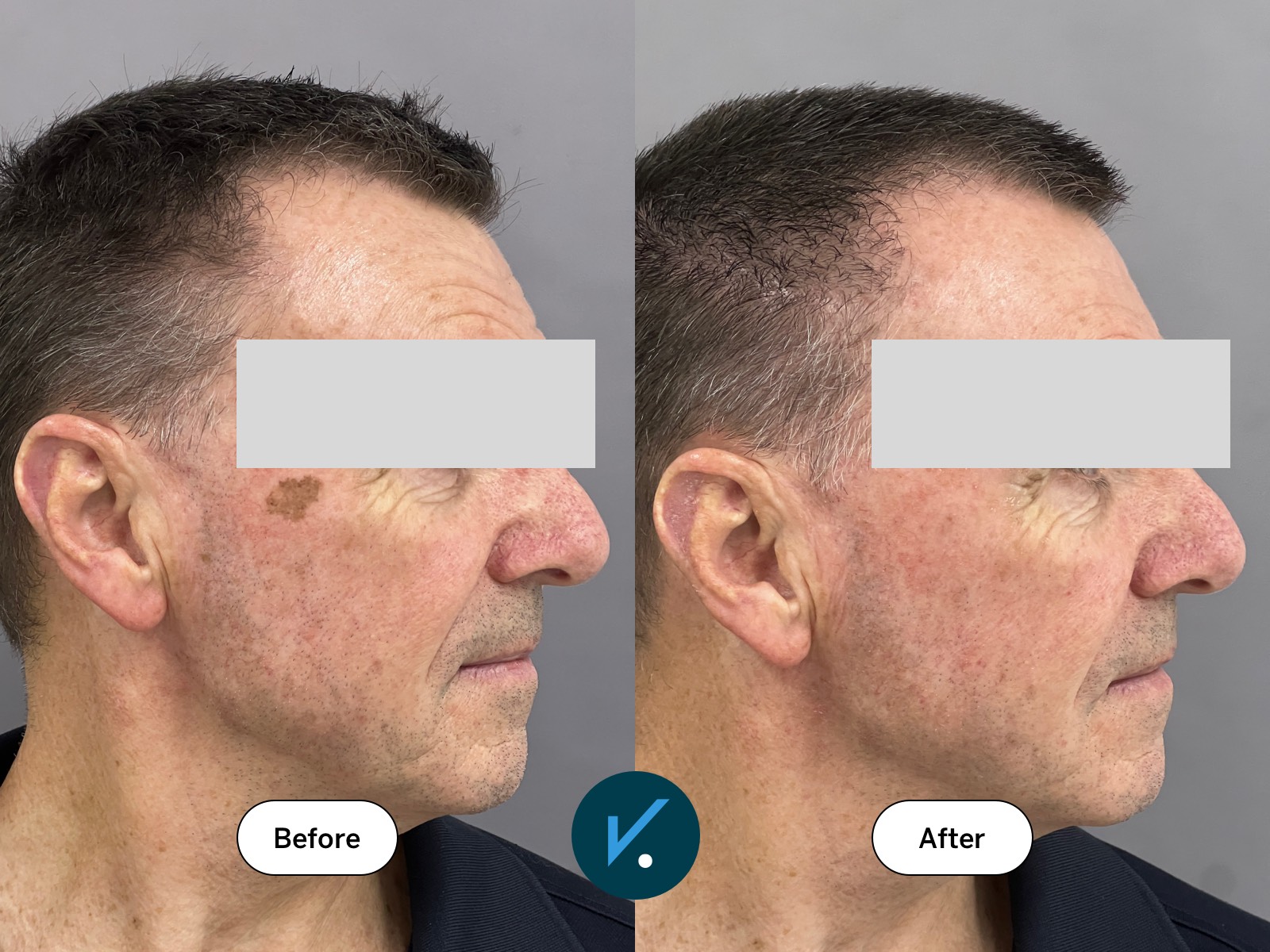 Before and after laser treatment of lentigo (“age spot”)