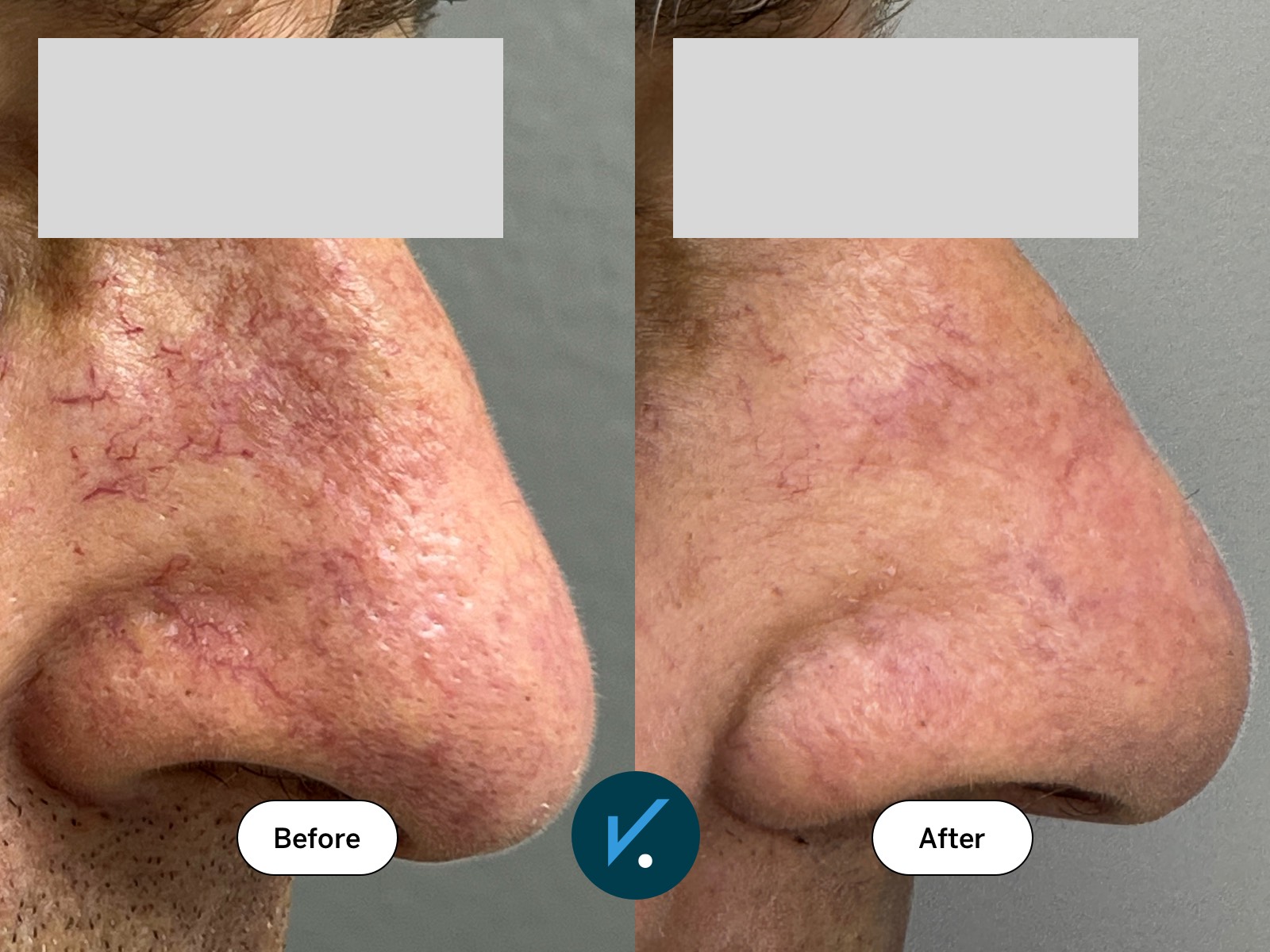 Before and after one laser treatment of telangiectasia (capillaries) on the nose