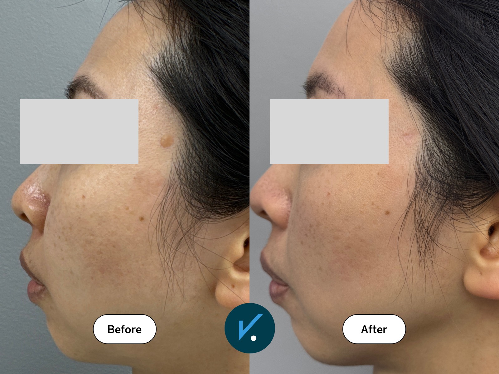 Laser mole removal - before and after