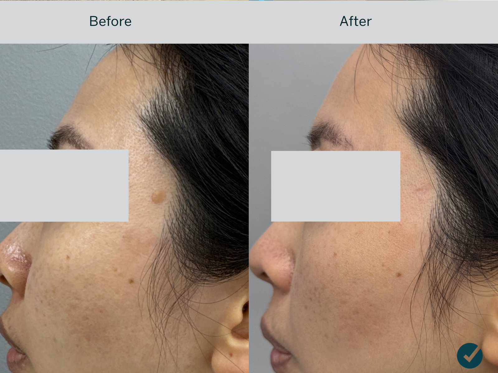 Before and after laser removal of a flat facial mole on the temple