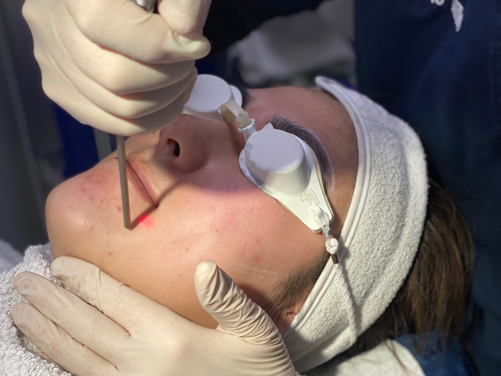 Patient undergoing laser pigment treatment