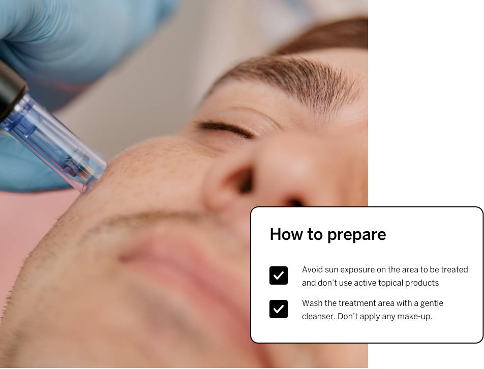 Microneedling - how to prepare