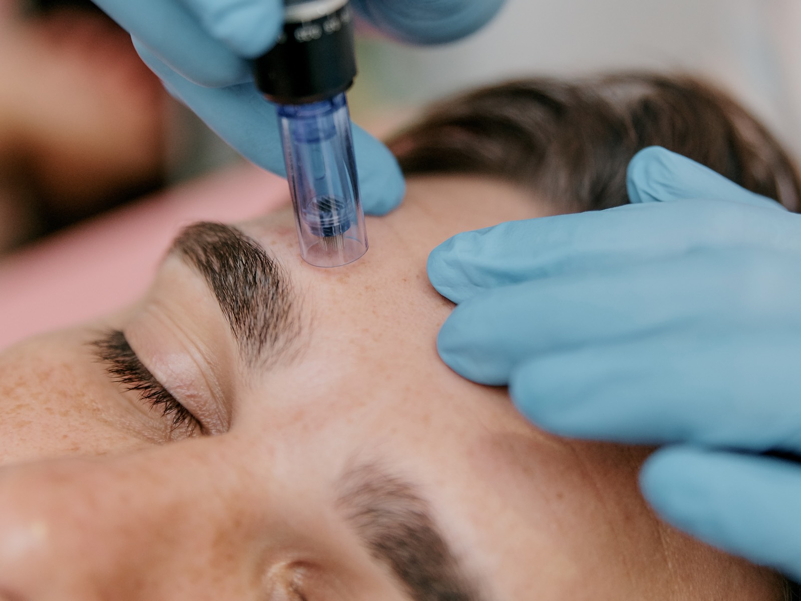 Man during microneedling treatment