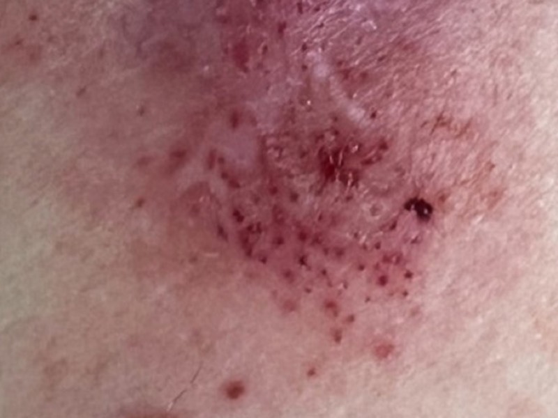 Pinpoint bleeding after fractional ablative laser treatment