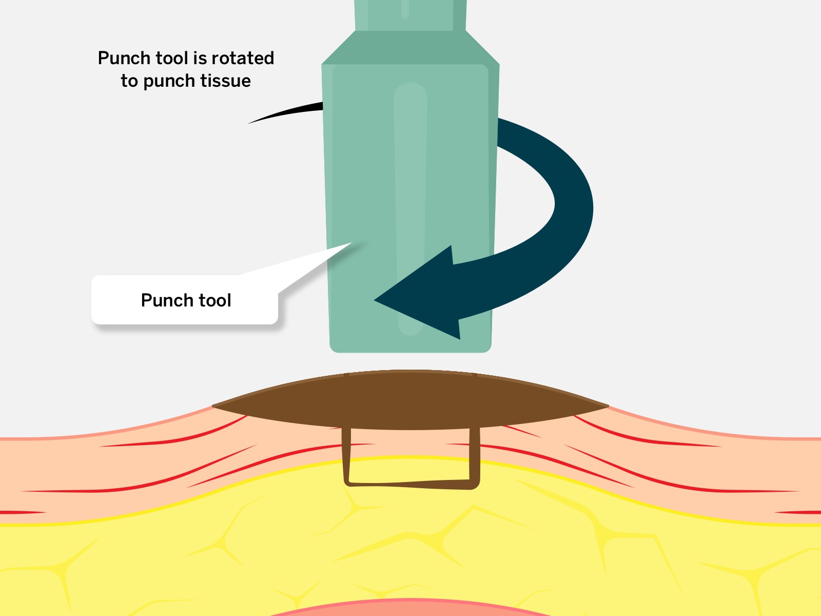 Punch biopsy - how it's done