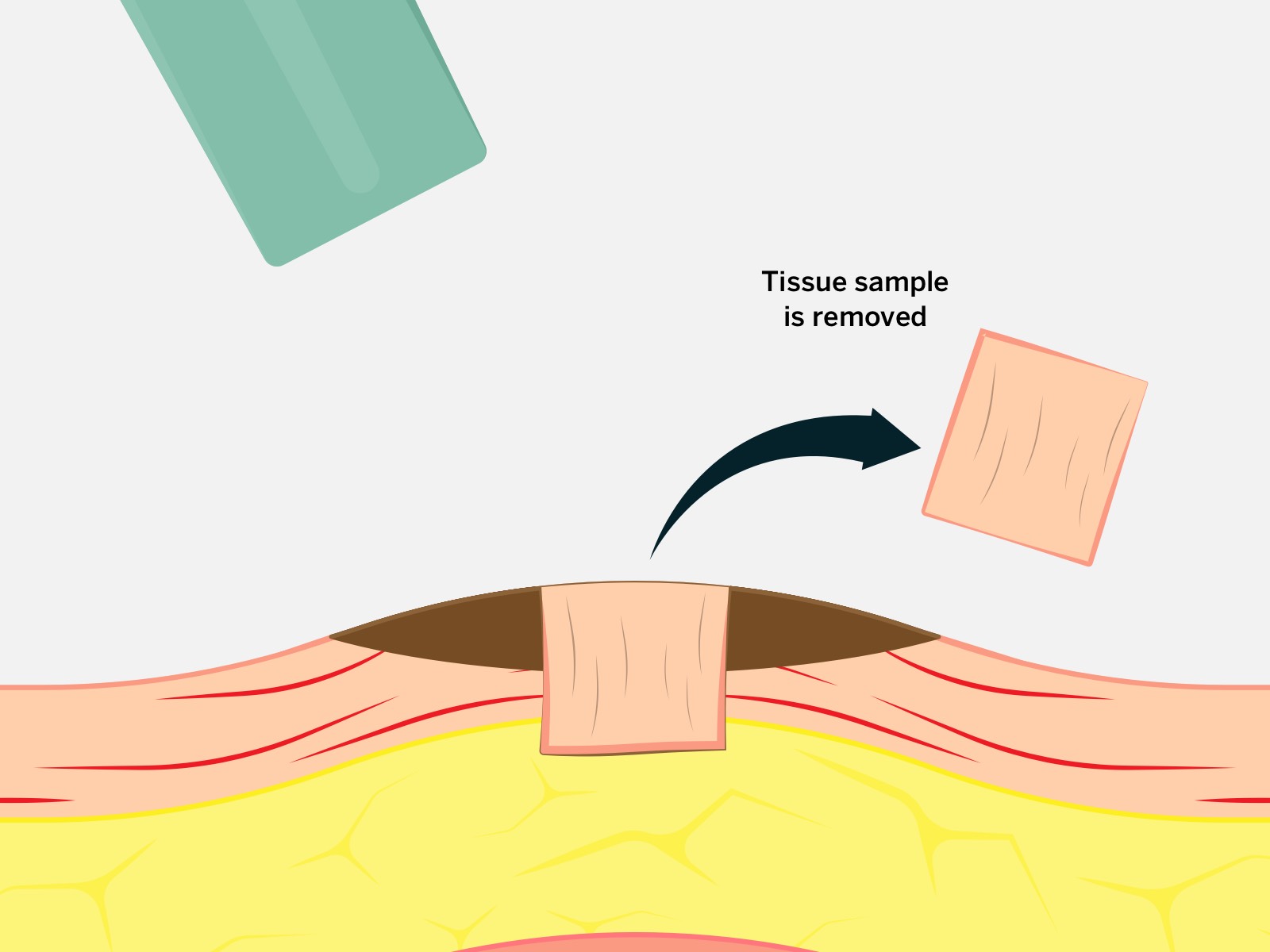 Punch biopsy - how it's done