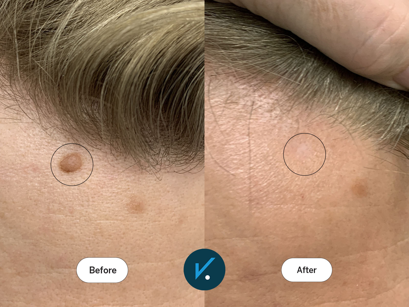 Radiofrequency mole removal - before and after