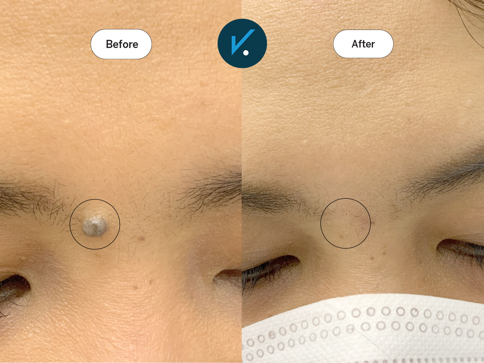 Radiofrequency mole removal - before and after