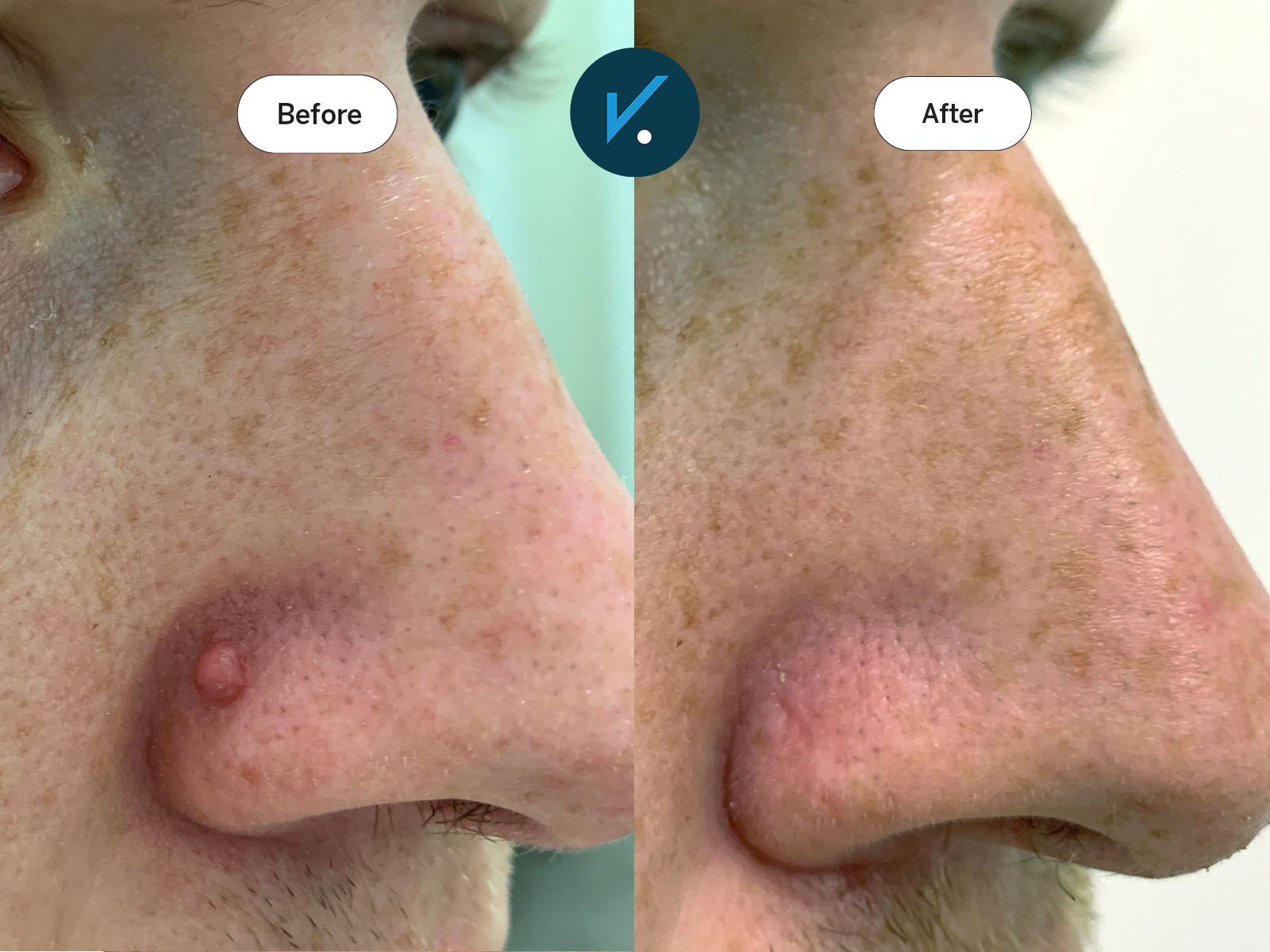 Radiofrequency mole removal - before and after