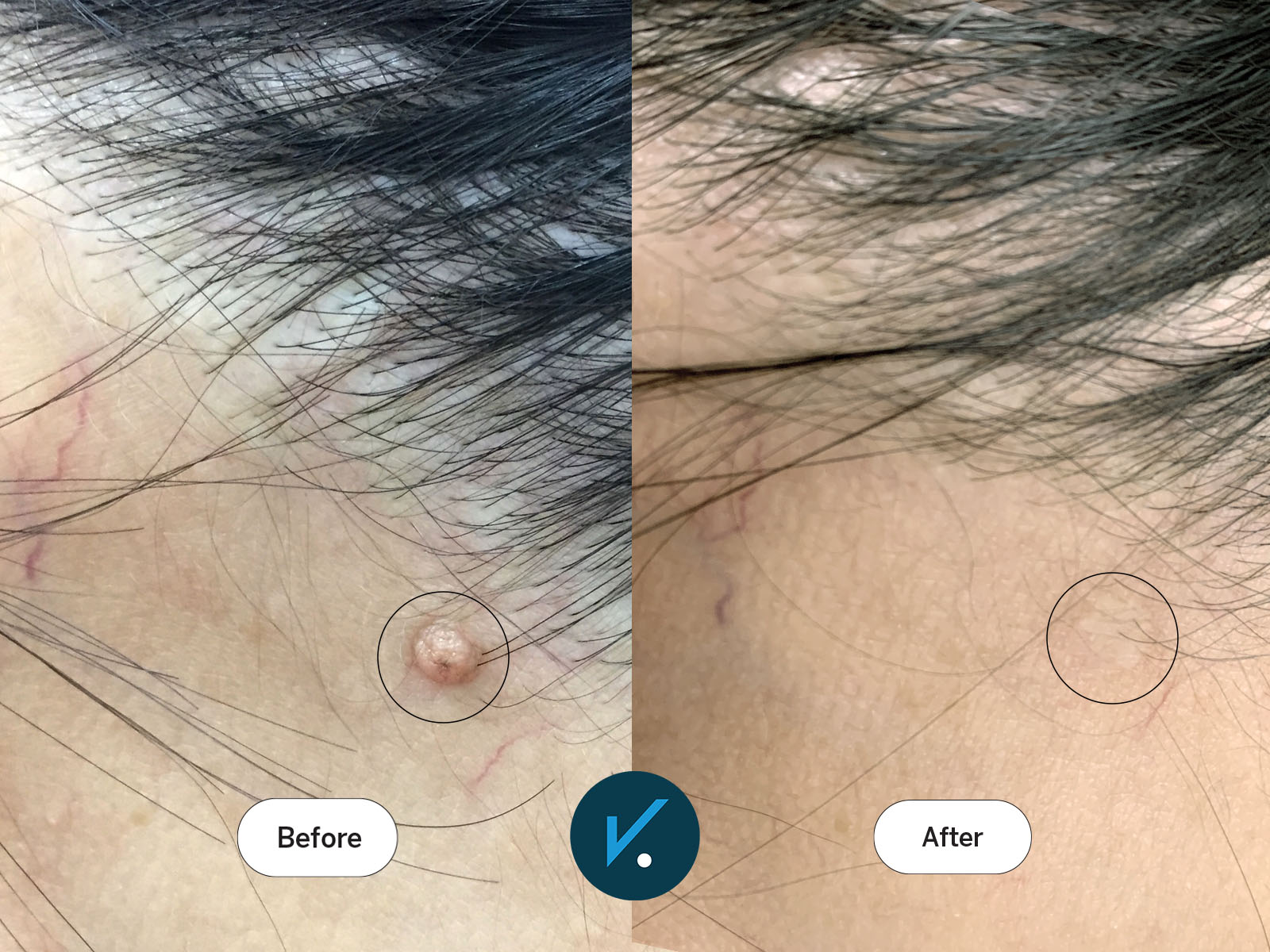 Radiofrequency mole removal - before and after